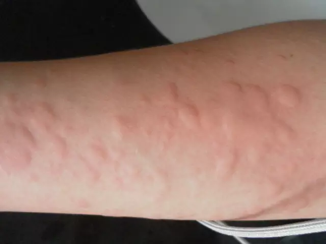 儿童常见过敏性疾病的诊疗及用药
