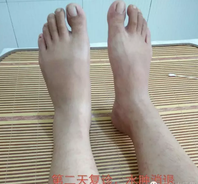 单侧下肢水肿,可以试试浮针