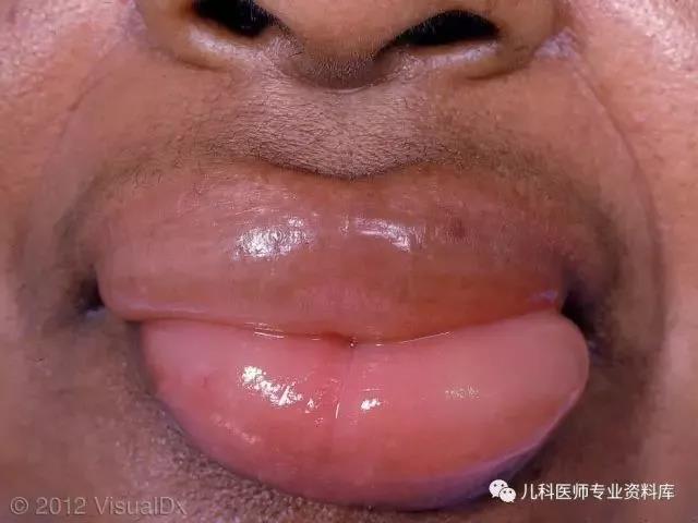 幼儿急疹,风疹,麻疹,猩红热,水痘,荨麻疹,热疹,湿疹等等,皮疹怎么破?