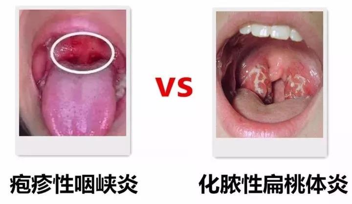 发热的症状,但如果病变部位在咽峡部的,可能就是病毒感染的疱疹性咽峡