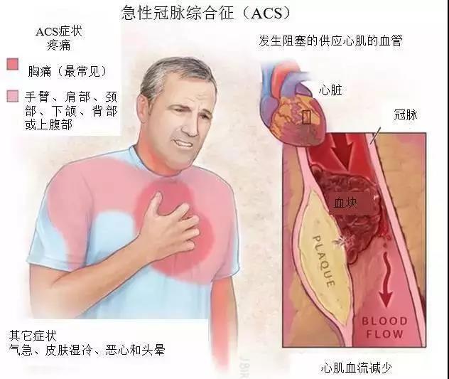 胸痛的来源: 1,胸廓或胸壁疾病:胸壁肌肉劳损,肋间神经痛,带状疱疹等
